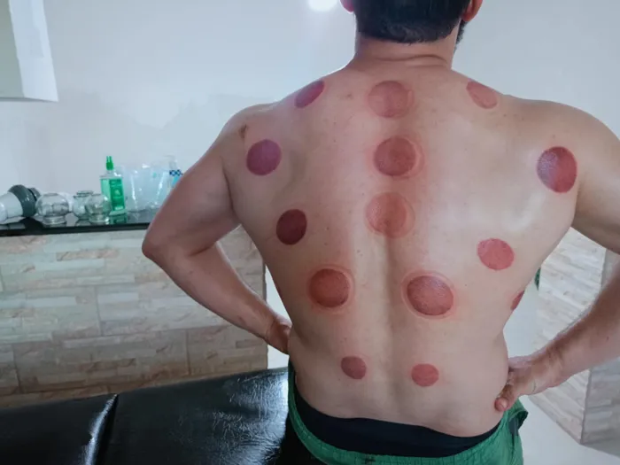 الحجامة و التحفيز الرياضي cupping tipaza خبرة 13 سنة في المي