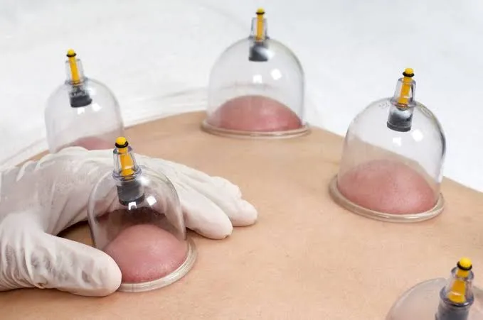 الحجامة hijama